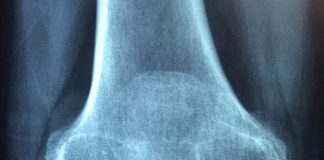 Reumatyczne zapalenie stawów